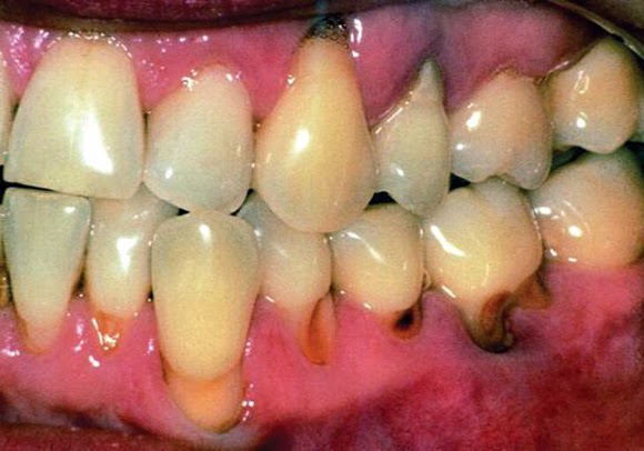 caries radicular en pacientes geriatricos